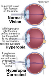 Farsightedness (Hyperopia) - Christopherson Eye Clinic